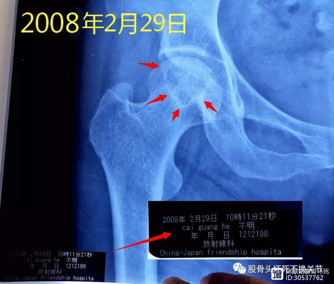 双鸭山人工骨头医保报销多少(人工骨头医保报销多少比例)