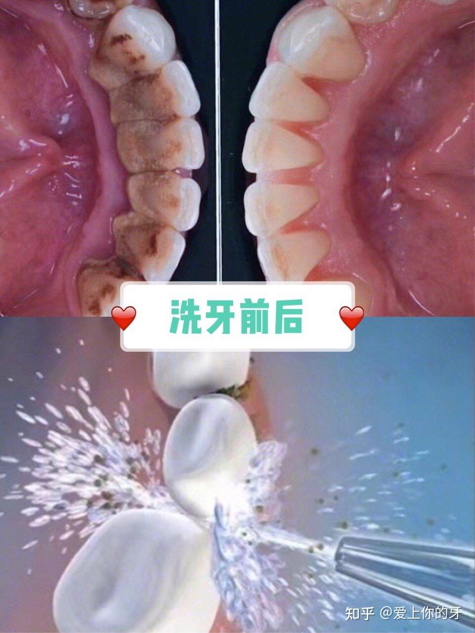 双鸭山洗牙可以用医保吗(洗牙可以用医保吗,报销比例多少)